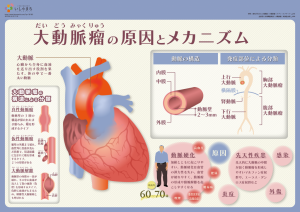 大動脈瘤の原因とメカニズム