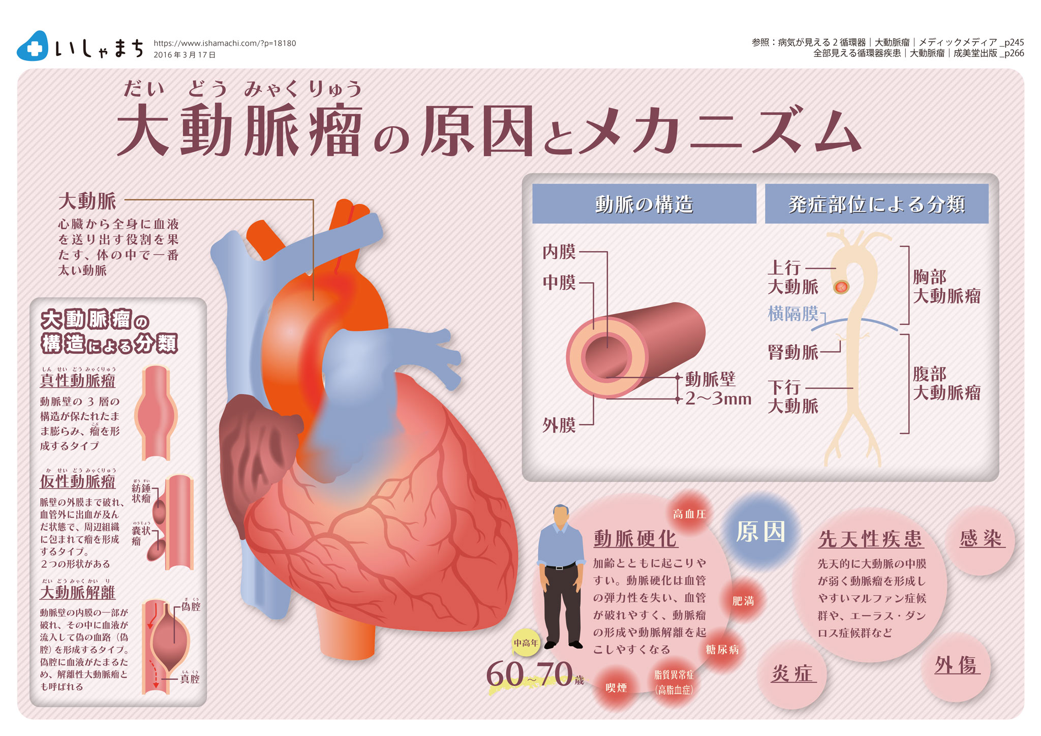 大動脈瘤の原因とメカニズム-図解