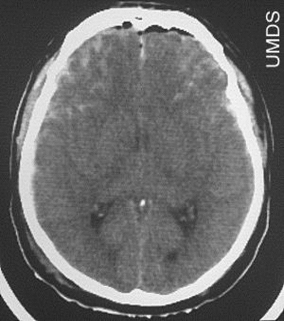脳挫傷のCT画像