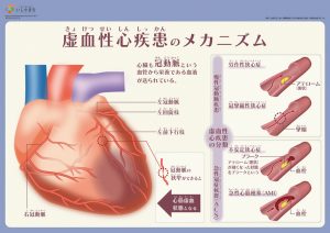 虚血性心疾患のメカニズム