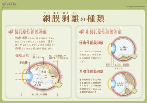 網膜剥離の種類