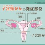 子宮頸がんの発症率