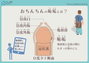 おちんちんの恥垢とは？