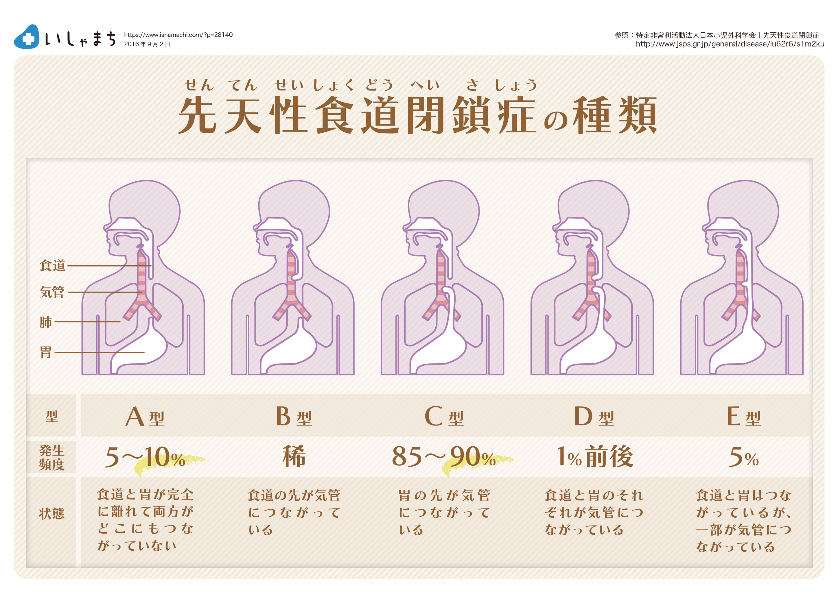 先天性食道閉鎖症の種類-図解