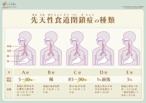 先天性食道閉鎖症の種類