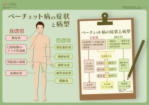 ベーチェット病の病状と病型