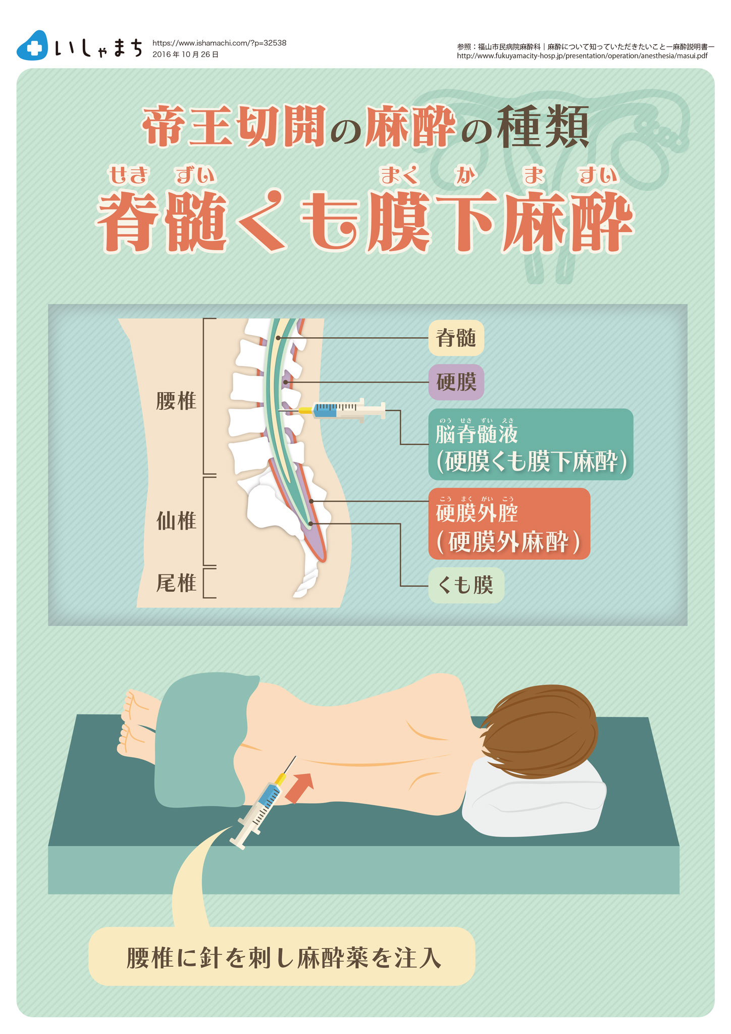 帝王切開の麻酔の種類-脊髄くも膜下麻酔-図解