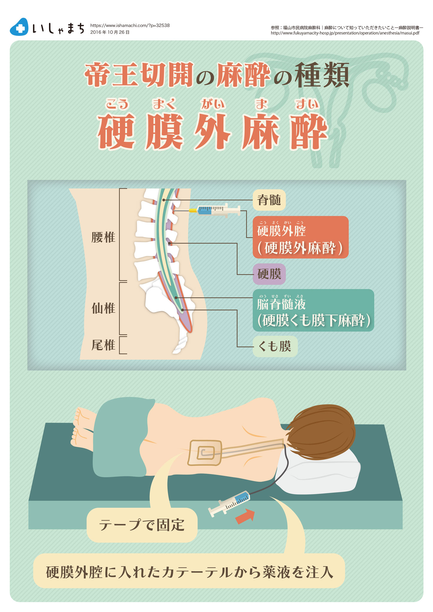 帝王切開の麻酔の種類-硬膜外麻酔-図解