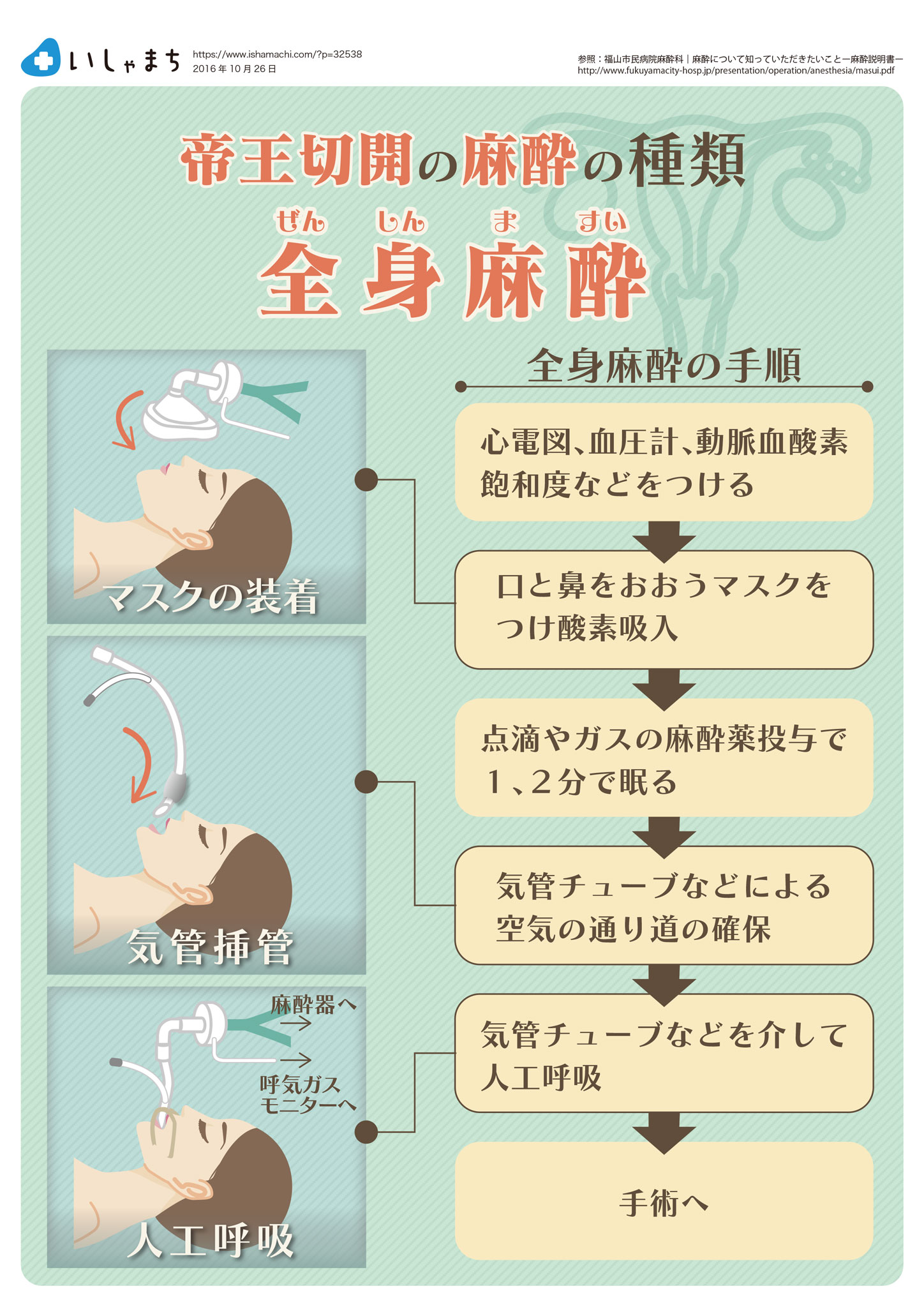 帝王切開の麻酔の種類-全身麻酔-図解