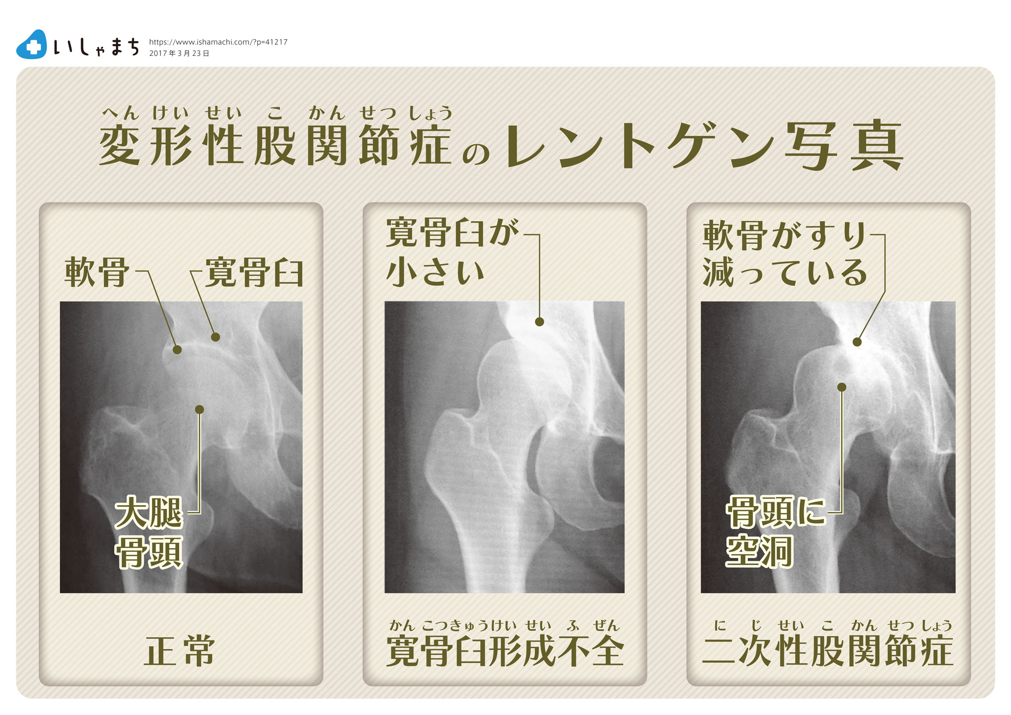 変形性股関節症のレントゲン写真-図解