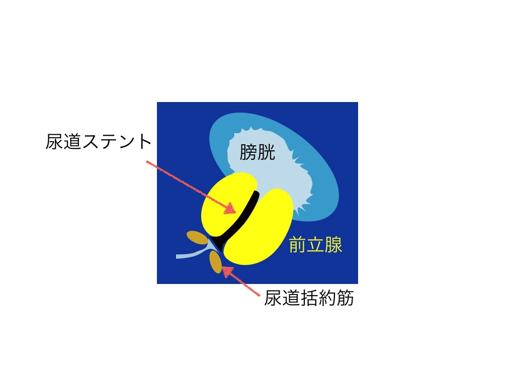 尿道ステント 留置したところ-イラスト