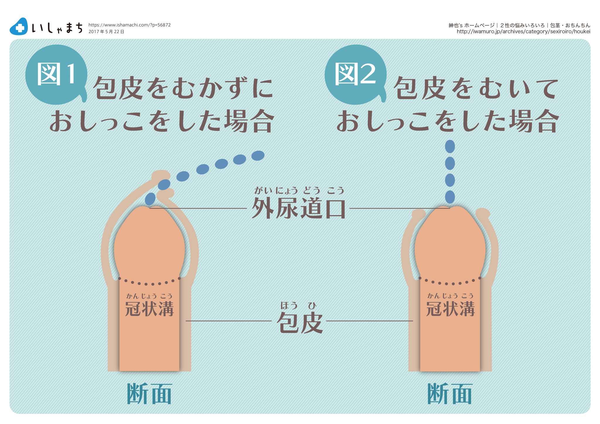 包皮をむかずにおしっこをした場合-むいておしっこをした場合-図解