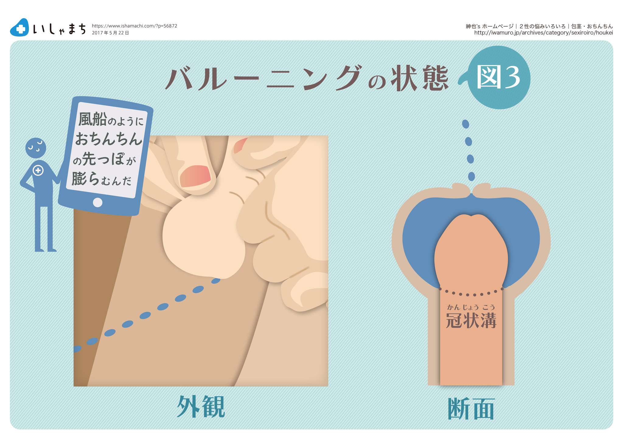 バルーニングの状態-図解