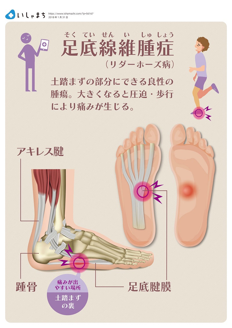 かかとが痛い 病院に行くべき 原因は いしゃまち