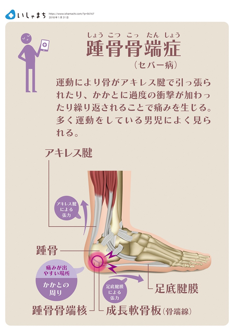 かかとが痛い 病院に行くべき 原因は いしゃまち