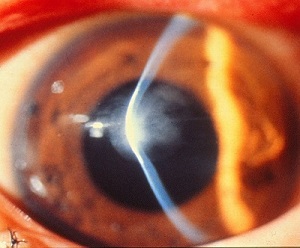 円錐角膜の症例