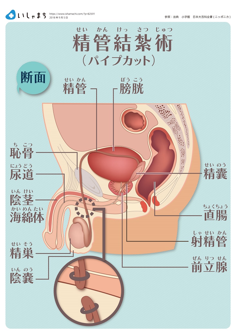 精管結紮術